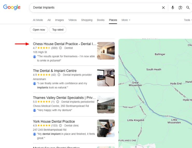 Chess House Dental Implants Result