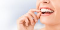 Clear Aligners